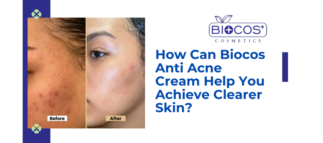How Can Biocos Anti Acne Cream Help You Achieve Clearer Skin?