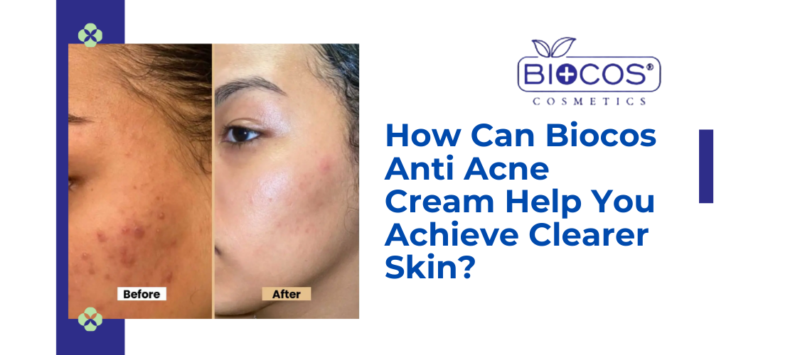 How Can Biocos Anti Acne Cream Help You Achieve Clearer Skin?