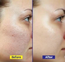 Open Pores