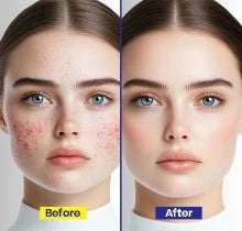 Acne & pimples