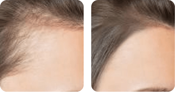 Hair Fall