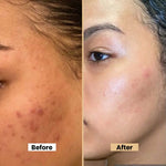 Anti Acne Spot Treatment Cream – Targets Pimples & Blemishes - Pack of 2