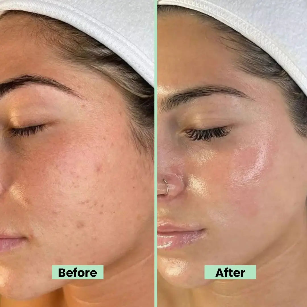 Multi Serum Aloe Vera – Hydrating & Brightening Skin Serum with Hyaluronic Acid, Vitamin C, Jojoba Oil, Green Tea – Anti-Acne, Anti-Inflammatory, Radiant Glow - 15ml