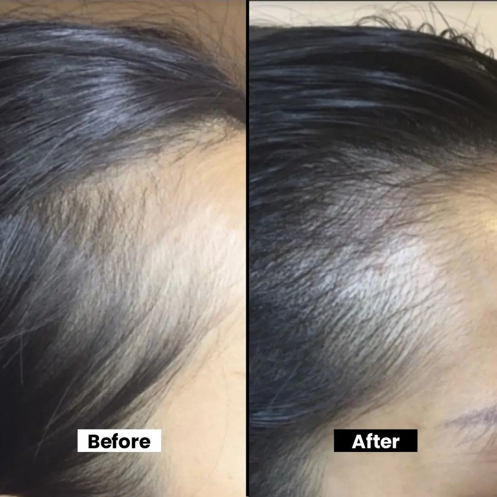 Hair Thick Ayurvedic Hair Oil – Anti-Hair Fall & Growth with Moringa, Amla, Brahmi, Neem, Coconut Oil – Dandruff Control, Strengthens & Nourishes for Thicker, Healthier Hair - 150ml