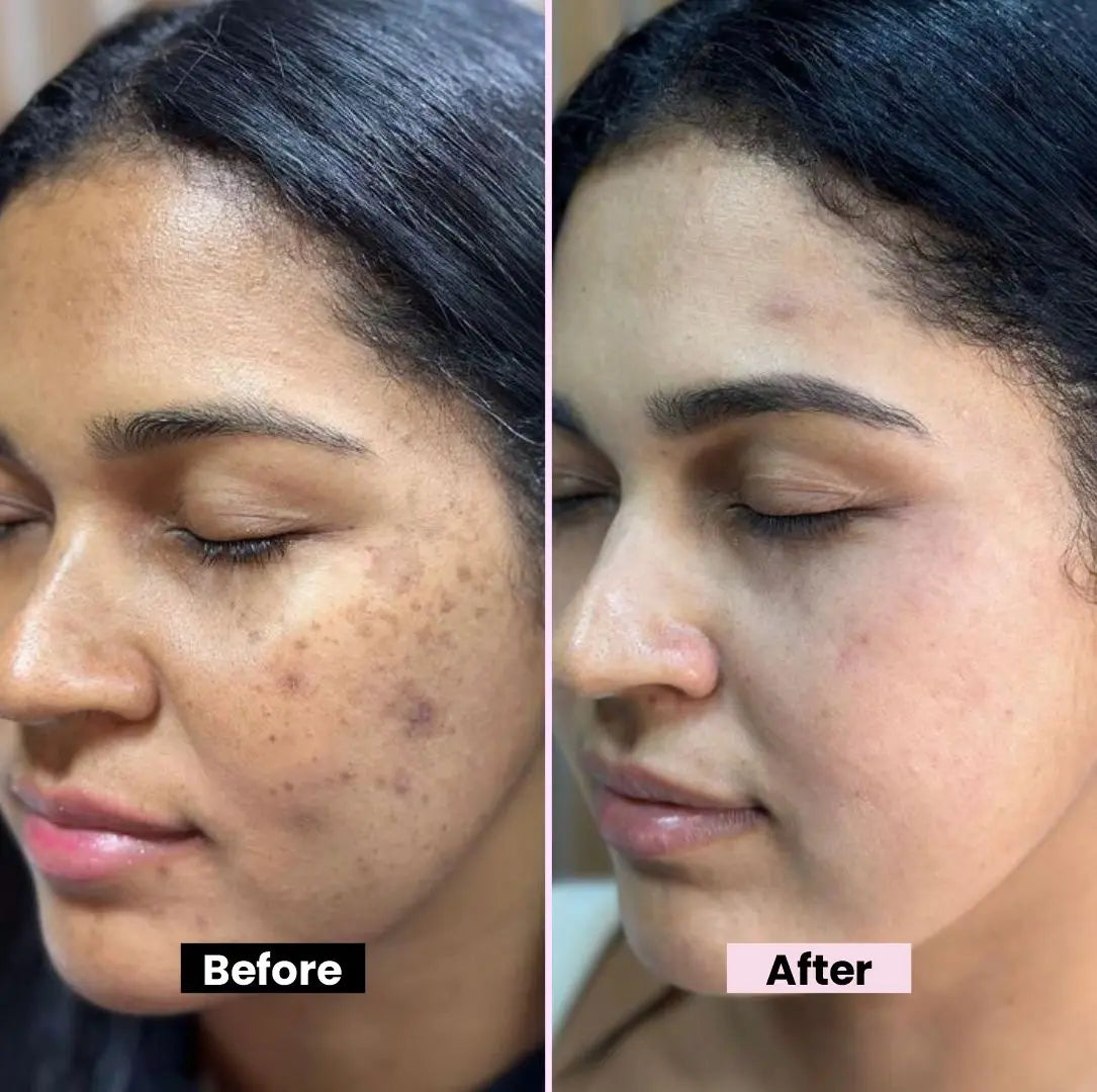 Kojic Acid Cream for Dark Spots & Hyperpigmentation | Skin Brightening & Acne Scar Removal | Enriched with Glycolic Acid, Aloe Vera & Vitamin B5 - 50gm
