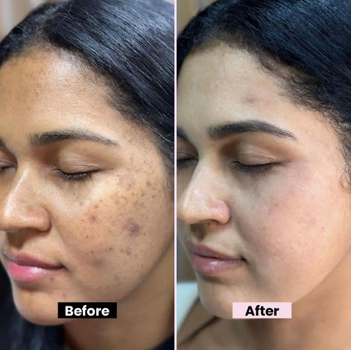 Kojic Acid Cream for Dark Spots & Hyperpigmentation | Skin Brightening & Acne Scar Removal | Enriched with Glycolic Acid, Aloe Vera & Vitamin B5 - 40gm