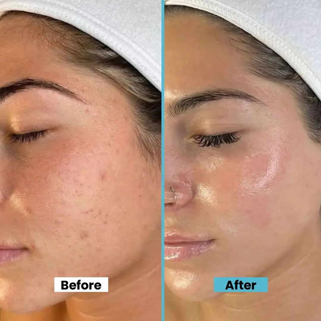 Multi Serum Hyaluronic Acid – Advanced Hydrating & Anti-Aging Facial Serum with Vitamin B3, Ethyl Ascorbic Acid, Rose Hydrosol – Minimizes Fine Lines, Balances Oil, Tightens Pores - 15ml